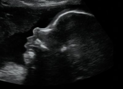 2D Ultrasound Profile Picture in the 3rd trimester.