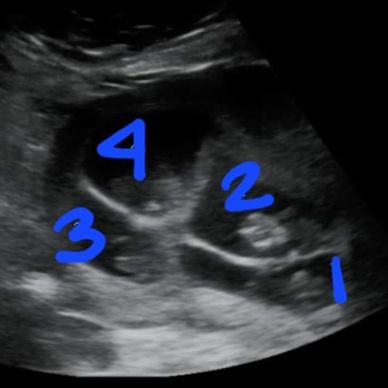 2D Ultrasound of all 4 Quadruplets!