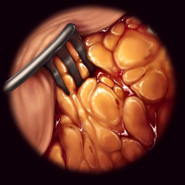 Subcutaneous Adipose Study