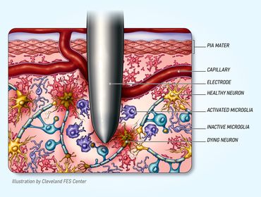 Affects of Long-Term Microelectrode Implantation