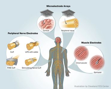 FES Electrodes