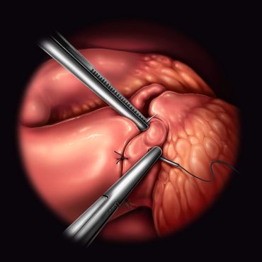 End-to-End Suturing Anastomosis