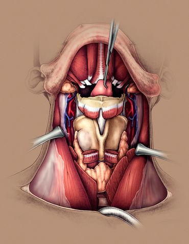 Total Laryngectomy
