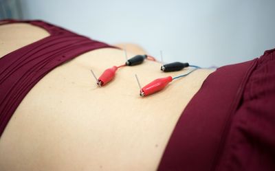 Dry needling with electrical stimulation