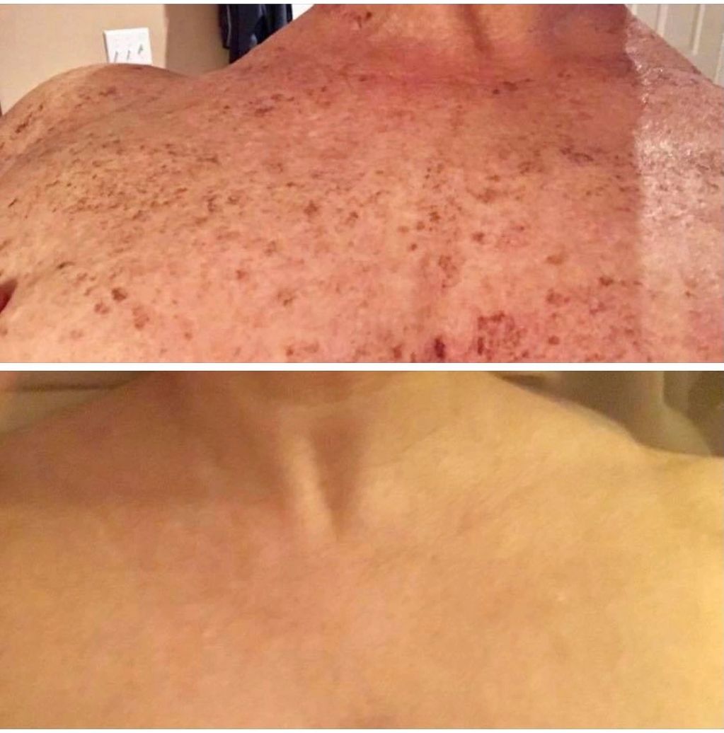 Before and After Photo Facial treatment to remove sun damage.