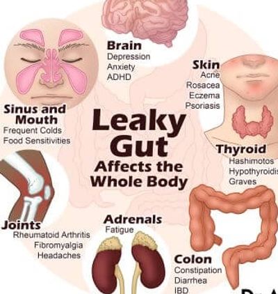 leaky gut, candida, autoimmune, constipation, colon hydrotherapy, colonics