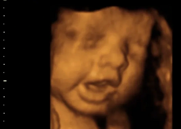 3D/4D Ultrasound