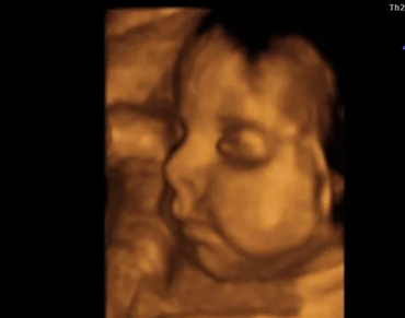 3D/4D Ultrasound