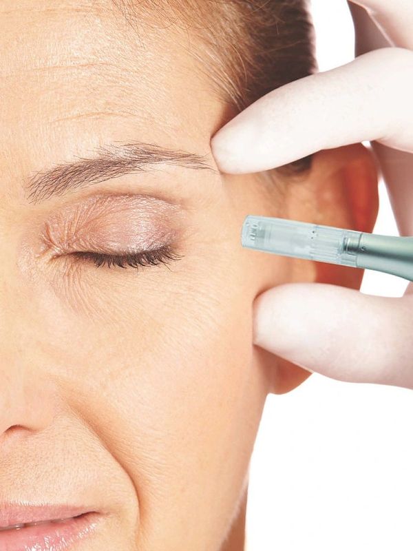 Mincroneedling PRP treatment