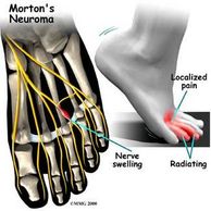 Morton's Neuroma