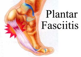 Plantar Fasciitis