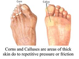 Corn and Calluses