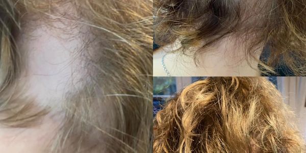PRF FOR HAIR RESTORATION ALOPECIA AREATA SKIN CLINICS LONDON FITZROVIA
