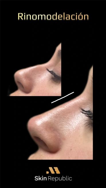 Rinomodelacion Tijuana
Rinomodelación
Rhinomodeling without surgery
Liquid rhinoplasty
Rinomodelacion
