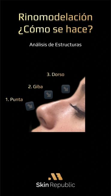 Rinomodelacion Tijuana
Rinomodelación
Rhinomodeling without surgery
Liquid rhinoplasty
Rinomodelacio