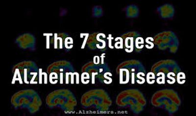 Stages of Alzheimer's Disease or Dementia 