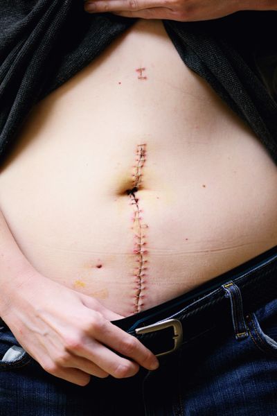 Surgery And Injury Recovery of abdominal surgery