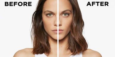 Fusio-Dose, before-and-after