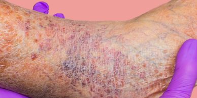 spider veins of the foot, varicose veins on the foot.