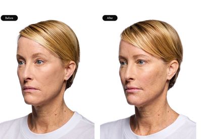 dermal fillers, lips filler in Las Vegas, aesthetic injector, nurse injector Las Vegas.