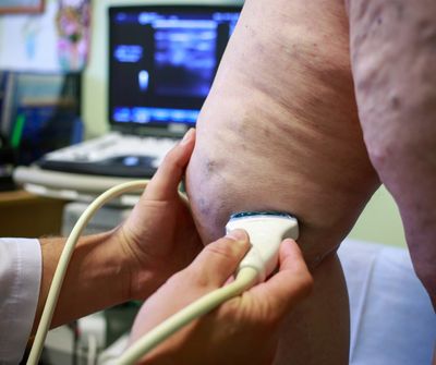 venous ultrasound, vascular ultrasound, ultrasound doppler, venous doppler ultrasound, Las Vegas