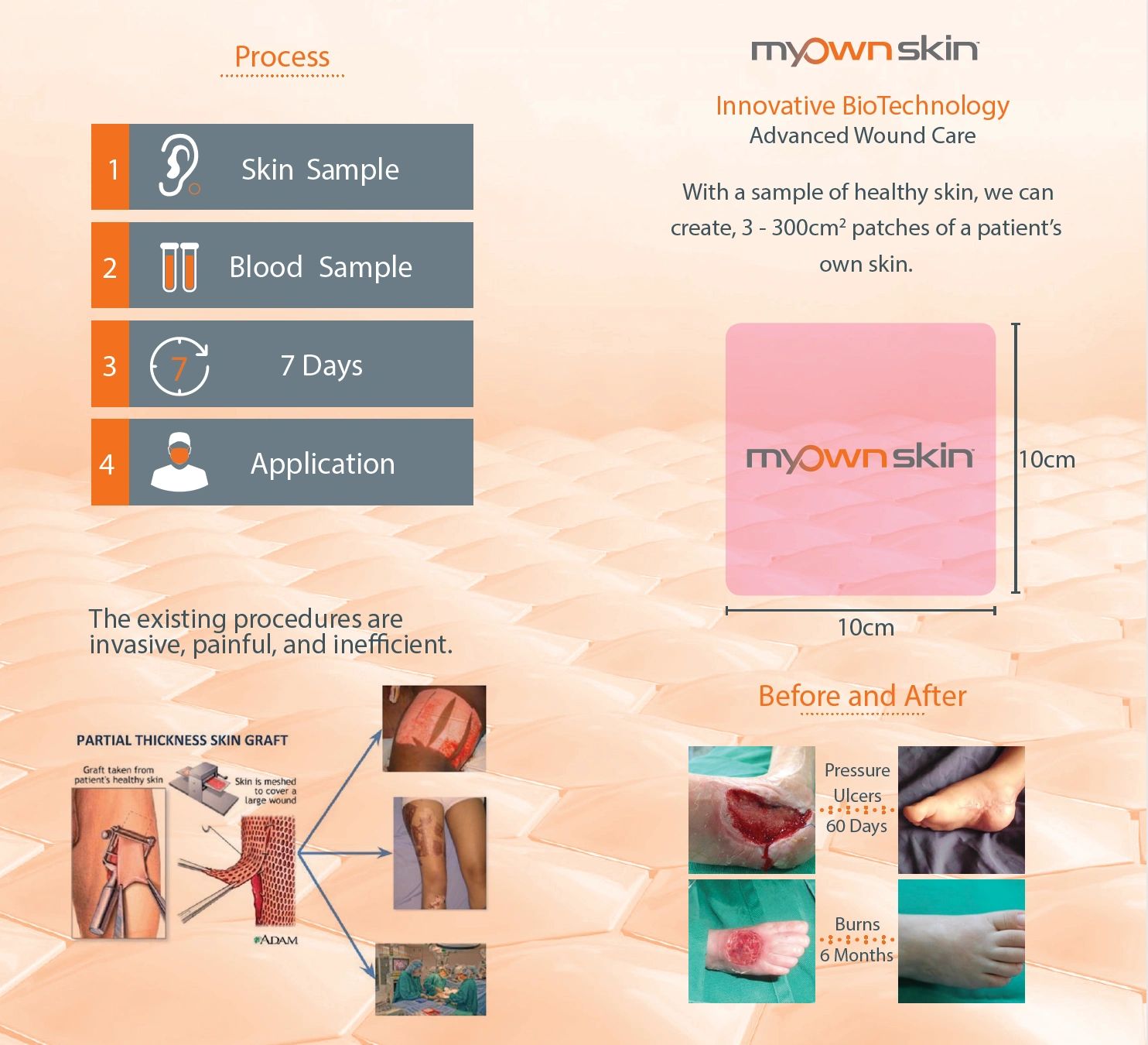 A Regenerative Approach
to Wound Care
Before and After
Process
MyOwn SkinTM is a non-surgical
proced