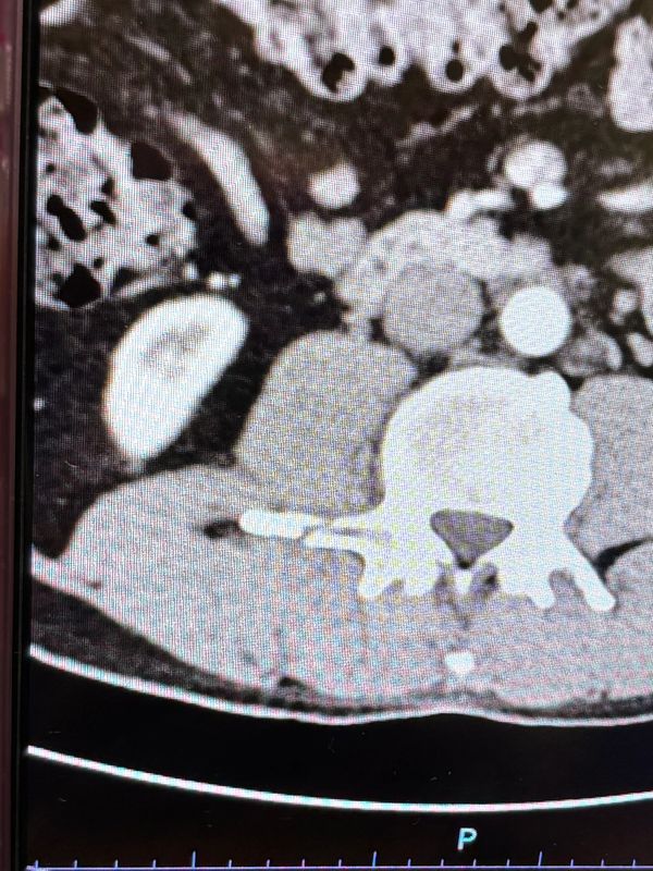 X-ray of my dad’s fractured vertebrae