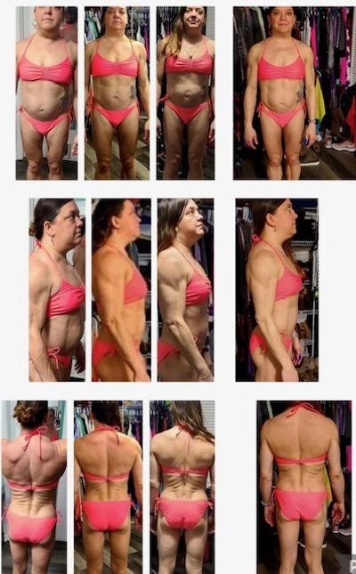 Images of Anne L demonstrate the way in which lipodystrophy affects her body.