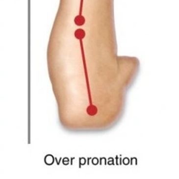 pronation foot orthopedic