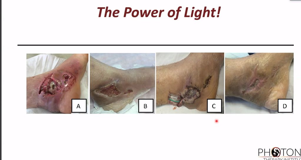 Ulcerated foot after Light Therapy treatment.
