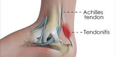 Apply 60 Second Pain Relief all the way around the affected area