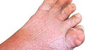 Apply 60 Second Pain Relief all the way around the affected area