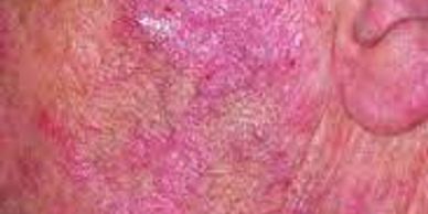 Apply 60 Second Pain Relief all the way around the affected area.