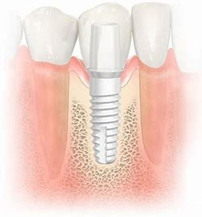 Biological friendly ceramic dental implant