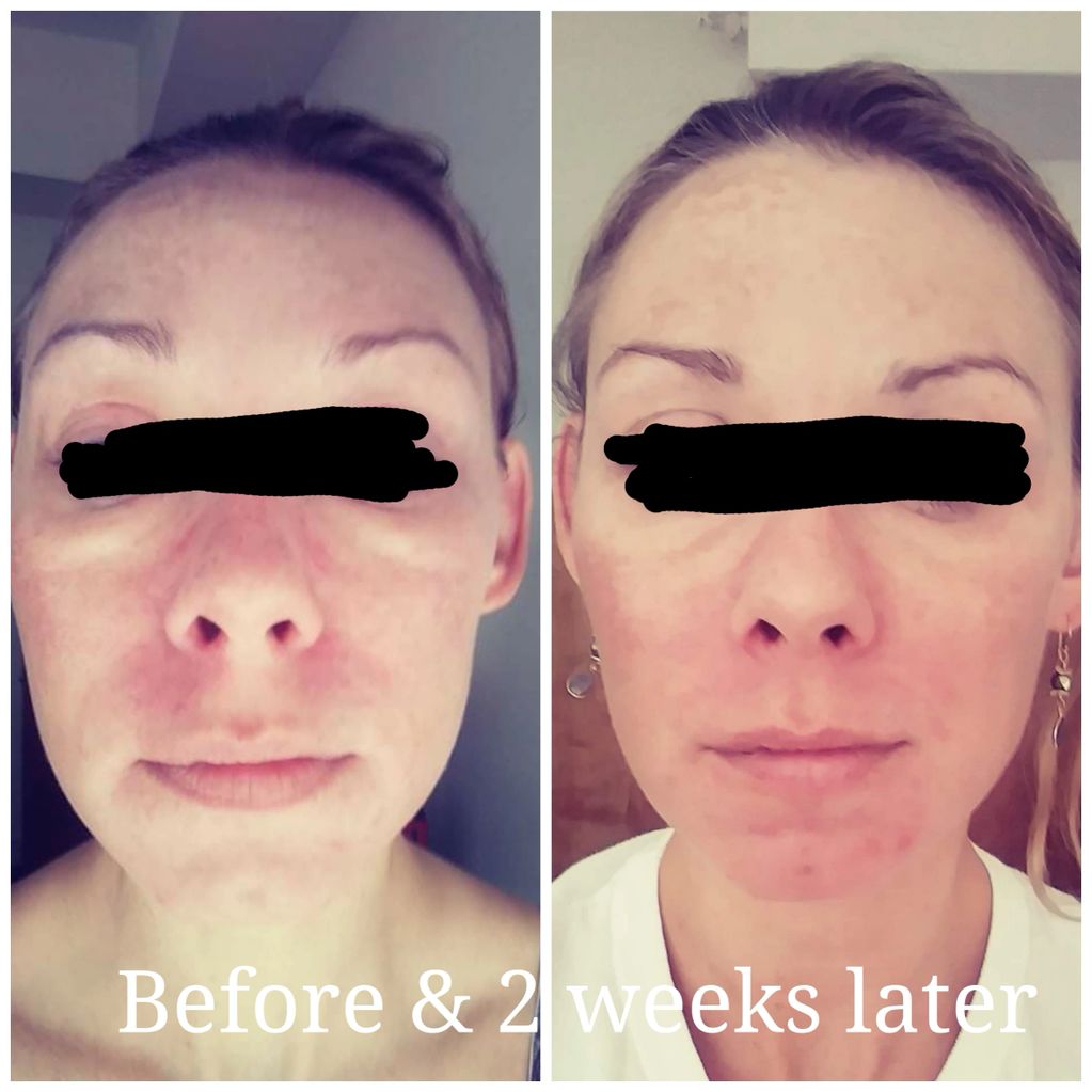 Beginning Of Treatment For Perioral dryness And Melasma