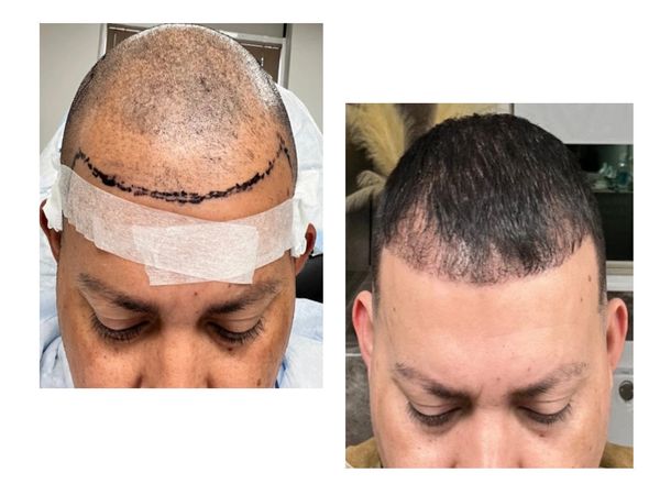 2200 FUE, 4 mths post op