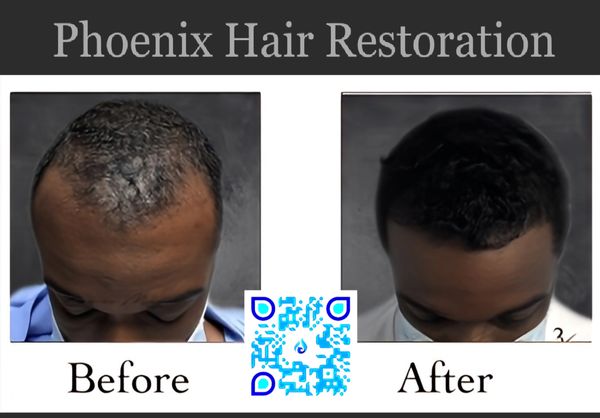 2500 FUE with PRP and Hair Serum