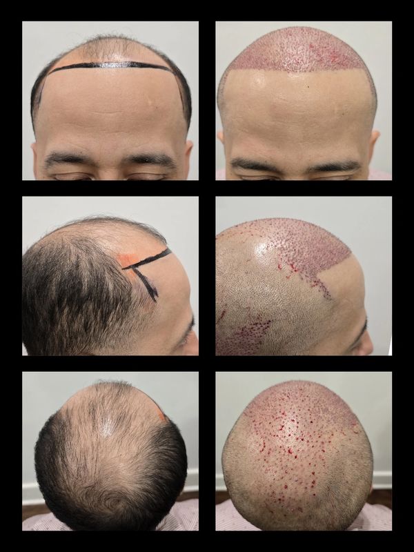 3000 FUE with PRP, Day One