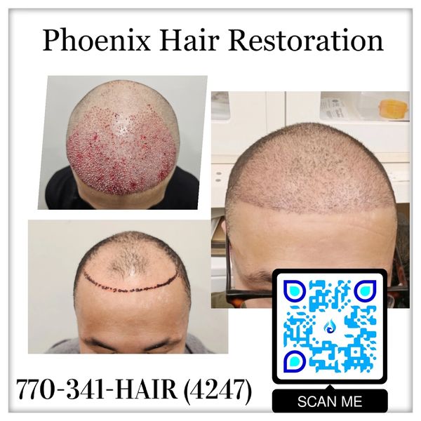 3000 FUE with PRP. 3 mth Post Op