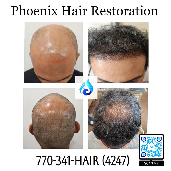 3000 FUE with PRP and Hair Serum