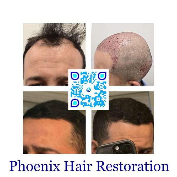 3000 FUE with PRP and Hair Serum