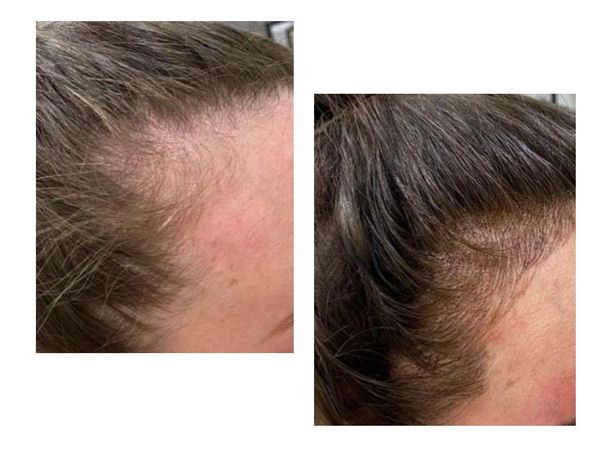 Hairline Microblading creates hair without surgery and it lasts for years. Instant results! 