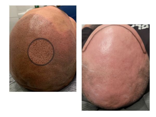 SMP, Scalp Micropigmentation