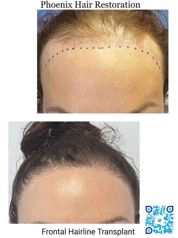 Feminine Frontal Hairline Transplant 2200 Grafts on a transgender patient.