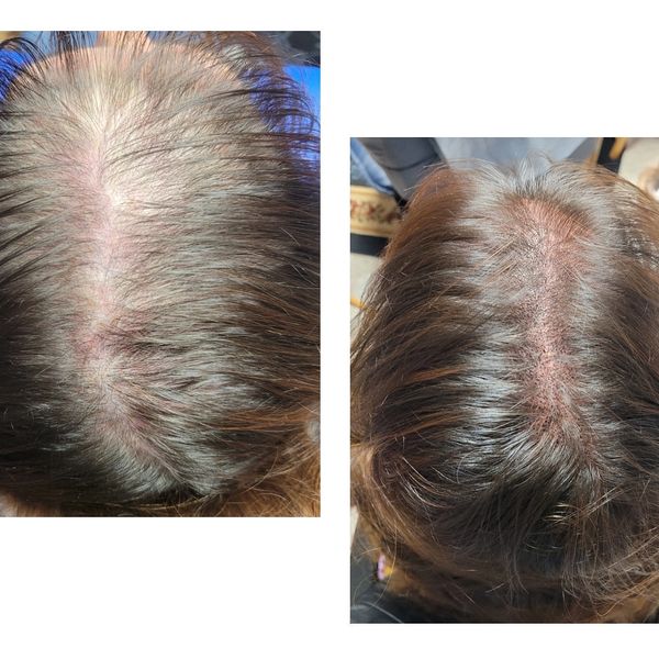 Female Scalp Micro-Pigmentation before & after treatment