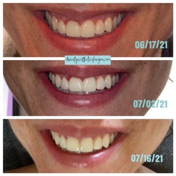 Bye, bye gummy smile!
