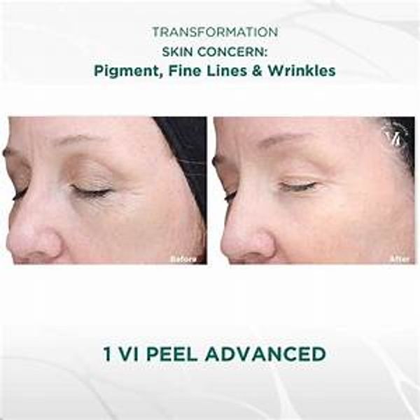 VI Peel Advanced smooths, softens and tightens skin.