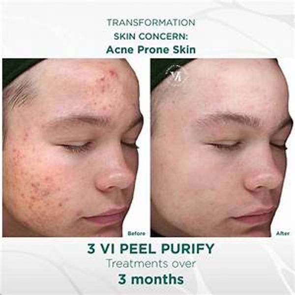 No one should have to suffer with acne.