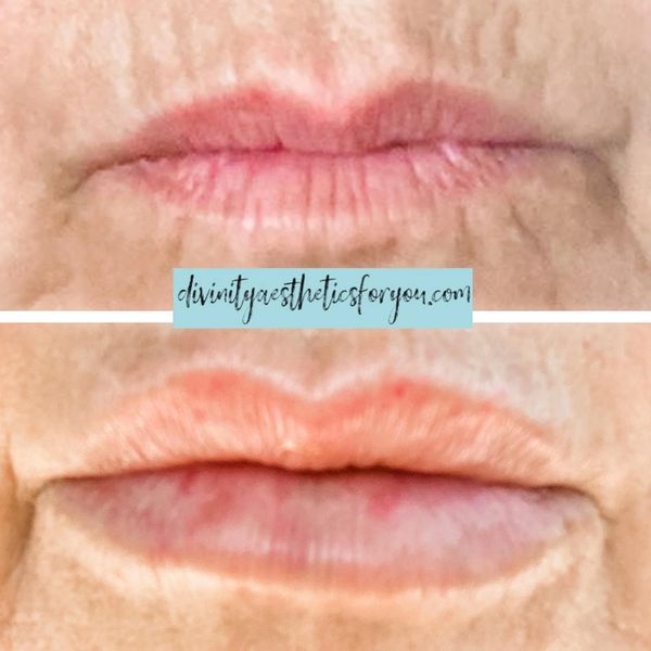 Lips aging you? Kiss those tattle-tale lines goodbye, baby!