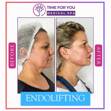Before and after photos showing facial improvement from endolifting treatment.